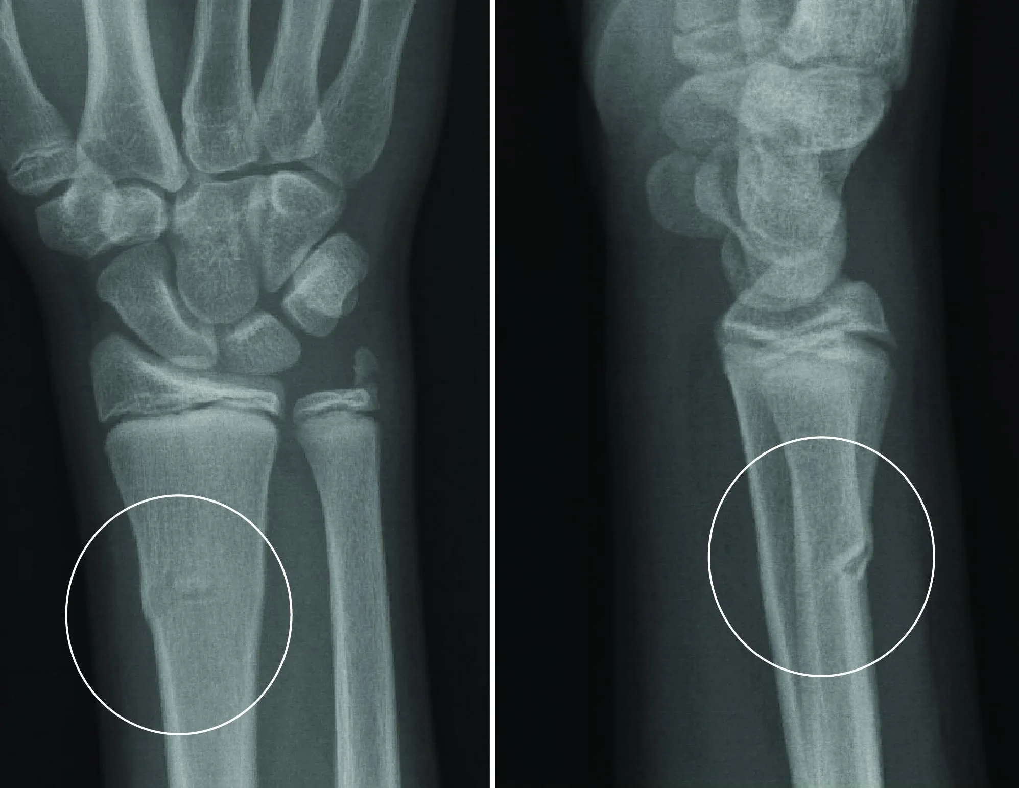 Buckle Fracture Raleigh Hand Surgery Joseph J. Schreiber MD
